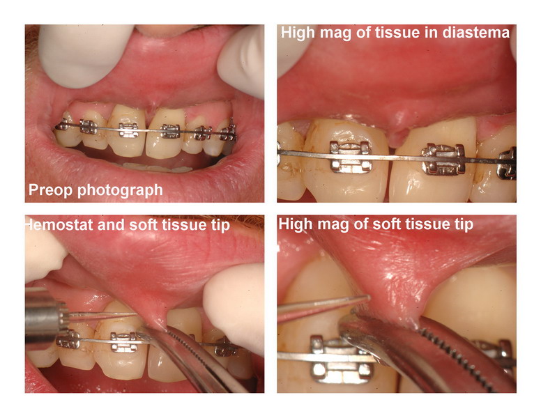 JP frenectomy edited pg 1_resize.jpg